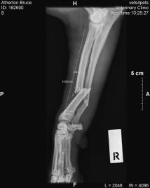 Broken ulna and radius.