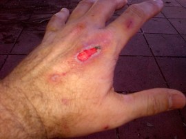 I took the skin-eating dressing off and just let it heal on its own.